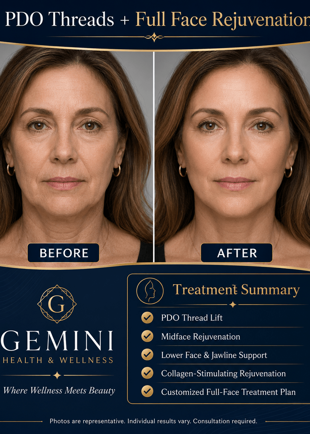 PDO Threads: Facial Balancing